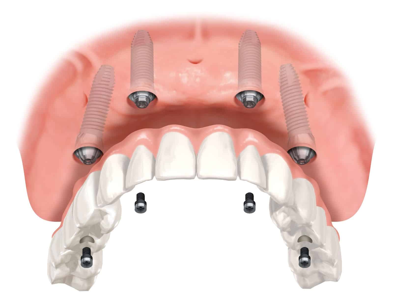 MA LO SAI CHE PER TORNARE A MASTICARE CON I DENTI FISSI SONO SUFFICIENTI POCHE ORE???  (e 4 impianti…)