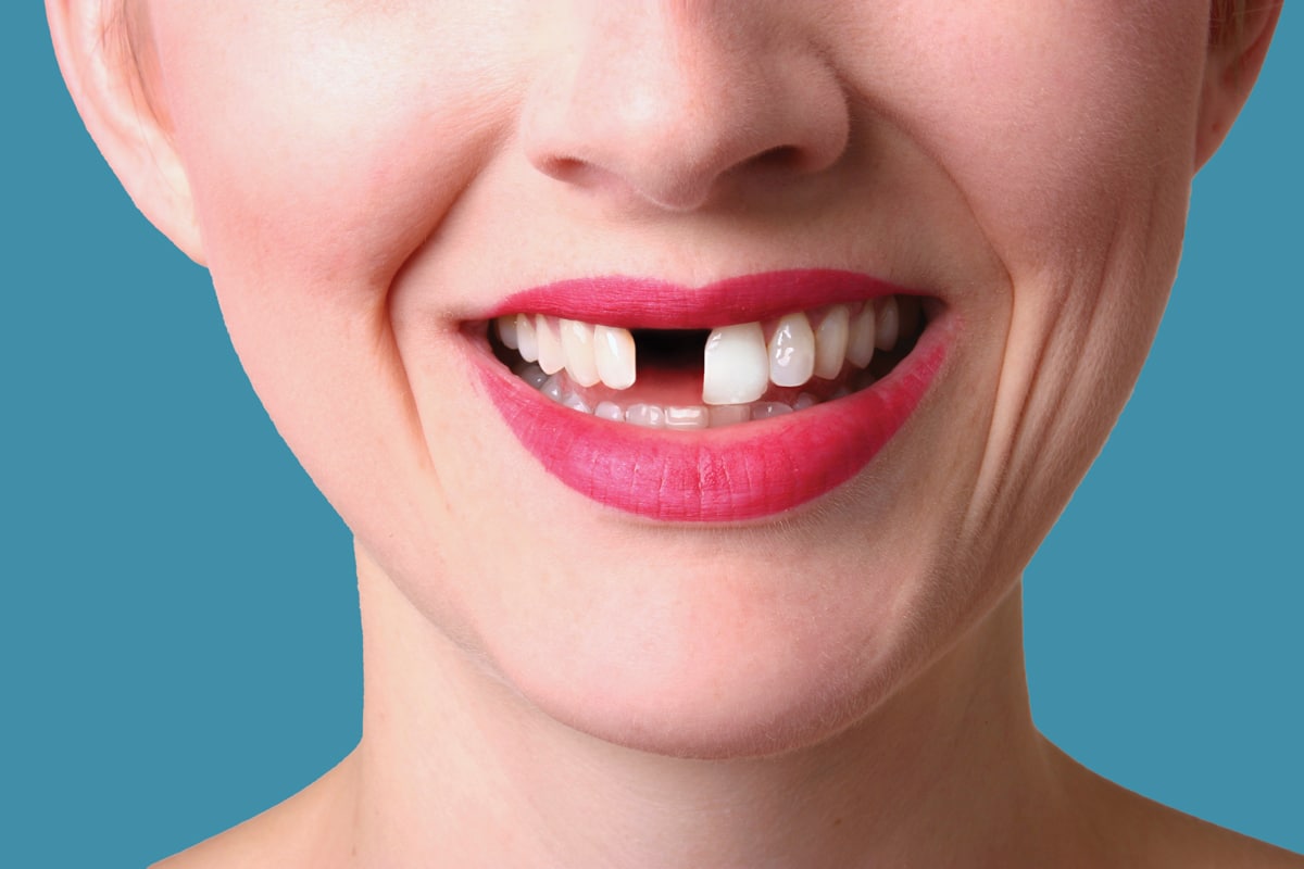 PERDERE UN DENTE PUO’ MANDARE IN “VACCA” TUTTA UNA PARTE DELLA TUA BOCCA!!!
